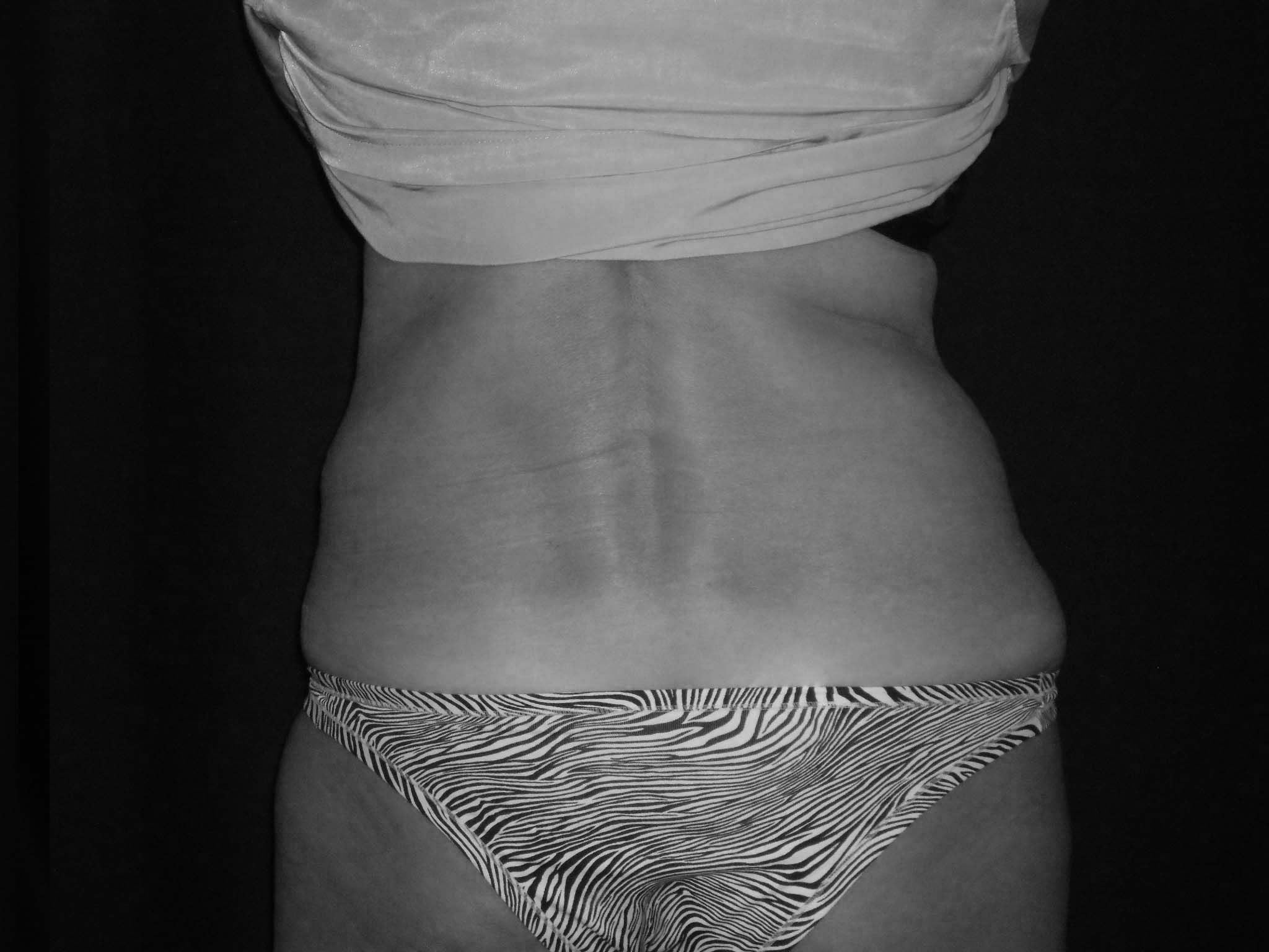 Coolsculpting, reduce la grasa en frío