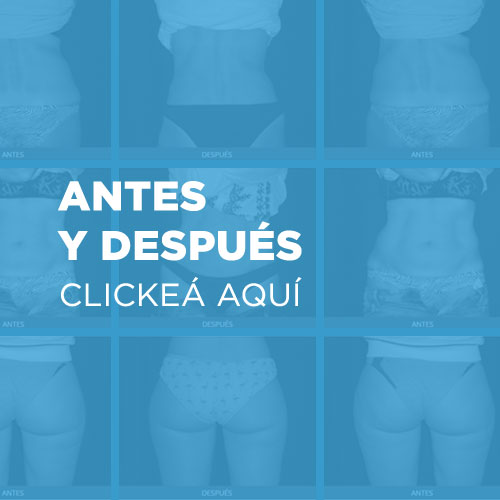 Antes y despues Coolsculpting
