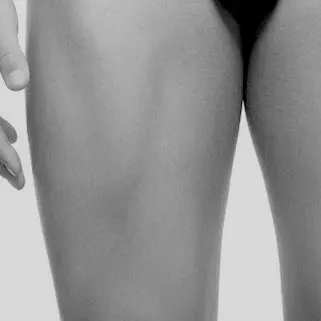 VELASHAPE MUSLO ANTERIOR